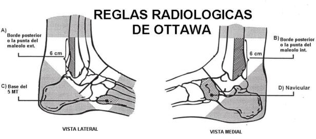 Reglas radiológicas de Ottawa